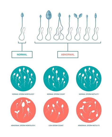 Infografía comparativa de espermatozoides sanos vs. espermatozoides afectados por el alcohol