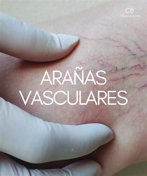 Ilustración mostrando las arañas vasculares y estrías comunes durante el embarazo.