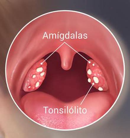 Imagen de tonsilolitos (pequeñas formaciones blancas o amarillentas en las amígdalas).