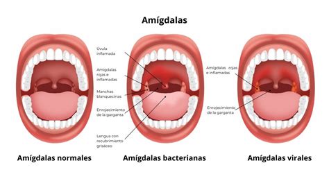 Diagrama que muestra la anatomía de la garganta, resaltando las amígdalas y sus criptas donde se forman los tonsilolitos.