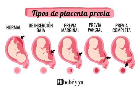 Esquema anatómico mostrando la diferencia entre una inserción placentaria normal en el fondo uterino y la placenta previa que obstruye el cuello del útero