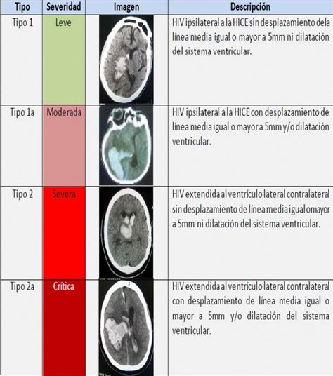 Imagen ecográfica de hemorragia intraventricular grado IV