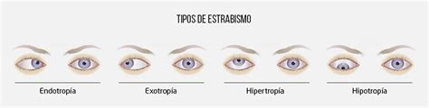 Ilustración mostrando diferentes tipos de estrabismo