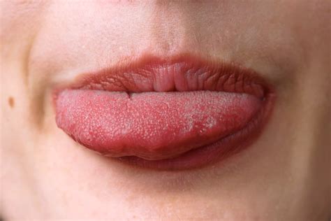 Fotografía clínica de papilitis lingual transitoria con papilas fungiformes inflamadas