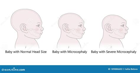 Infografía comparativa de un cráneo infantil normal, un cráneo con macrocefalia y un cráneo con microcefalia.