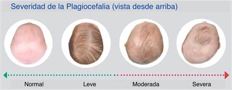 Ilustración comparativa de plagiocefalia posicional (izquierda) y sinostosis lambdoidea (derecha) vista desde arriba.