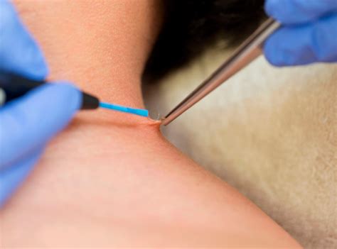Diferentes métodos para la eliminación de condilomas: láser, crioterapia, electrocoagulación