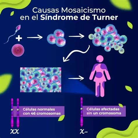 Esquema: Cariotipos del Síndrome de Turner (45,XO, mosaicismo)