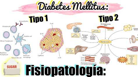 Ilustración de la fisiopatología de la Diabetes tipo 1 y el proceso autoinmune