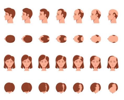 Diagrama comparativo mostrando los patrones de caída del cabello en hombres y mujeres, destacando las entradas y coronilla en hombres, y el ensanchamiento de la raya en mujeres.
