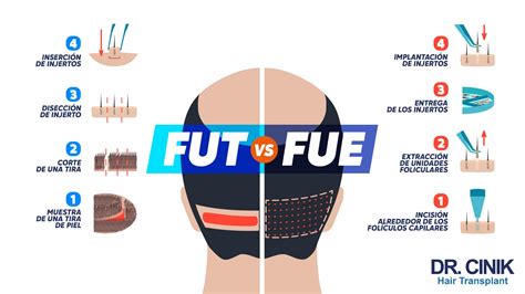 Ilustración del proceso de trasplante capilar, mostrando la extracción de folículos y su implantación en la zona receptora.