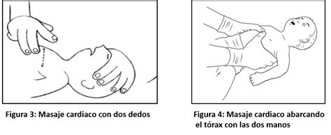 Masaje cardíaco abrazando el tórax en el lactante