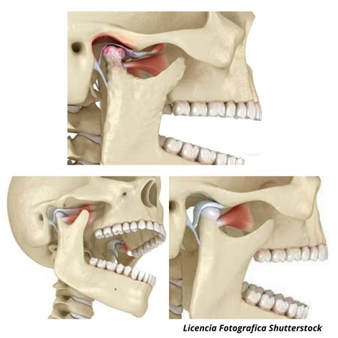 Elevación o subluxación mandibular