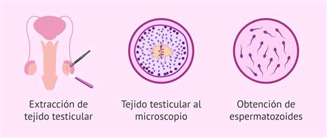 Esquema de la obtención de espermatozoides mediante biopsia testicular.