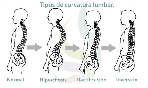 Esquema anatómico mostrando los cambios en la curvatura de la columna vertebral (hiperlordosis) durante las distintas etapas del embarazo.