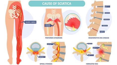Infografía ilustrativa sobre las zonas de dolor más frecuentes (lumbar, ciática, dorsal) y consejos de higiene postural.