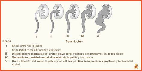 Esquema del reflujo vesicoureteral y su clasificación