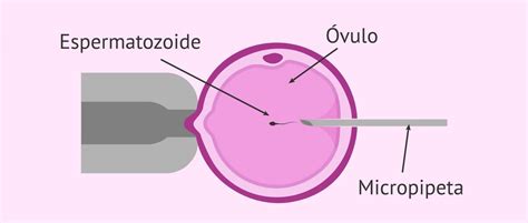 Fotografía del proceso de microinyección espermática
