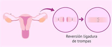 ilustracion de reversión de ligadura de trompas