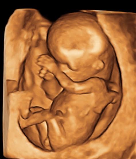 Imagen de ultrasonido 4D de un bebé de 12 semanas mostrando detalles faciales y corporales