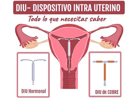 Esquema de un DIU hormonal y un DIU de cobre