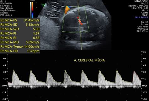 Gráfico que muestra la curva de Doppler de la arteria cerebral media para la detección de anemia fetal.