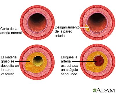 infografía sobre el proceso de aterosclerosis y estrechamiento de una arteria