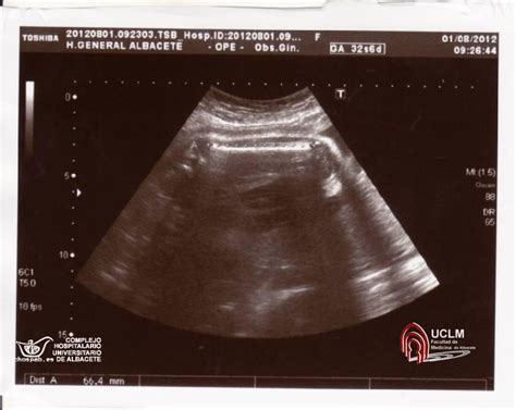 Ecografía fetal mostrando la medición del fémur y la relación con la longitud del pie