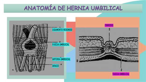 Esquema de la anatomía abdominal de un bebé con una hernia umbilical