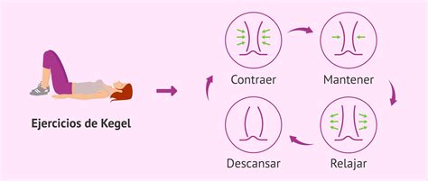 Ilustración mostrando la técnica correcta de los ejercicios de Kegel