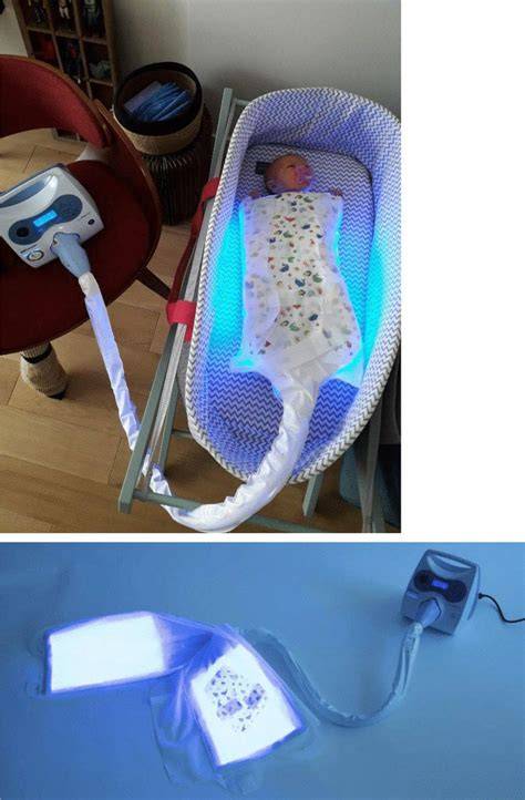 Comparativa visual de los dispositivos Bilicocoon Bag y Bilicocoon Blanket con fototerapia convencional
