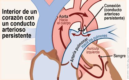 Ilustración que muestra el flujo sanguíneo anormal a través de un conducto arterioso permeable.
