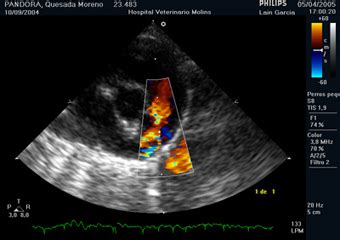 Representación de un ecocardiograma mostrando el flujo a través de un ductus arterioso permeable.