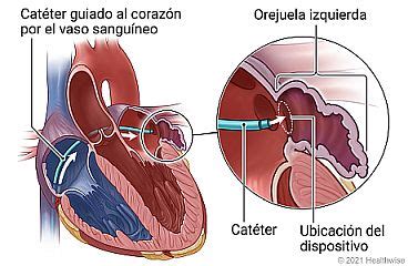 Diagrama ilustrando el procedimiento de cierre percutáneo de un conducto arterioso con un dispositivo oclusor.