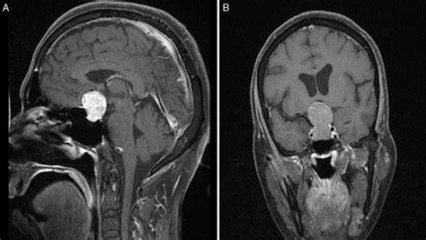 Resonancia magnética de un macroadenoma hipofisario con hemorragia intratumoral