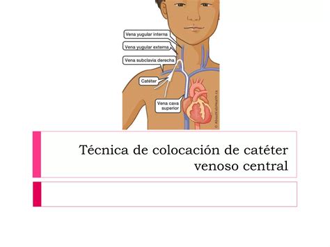 Esquema anatómico mostrando el trayecto de un catéter desde la ingle hasta las cavidades cardíacas