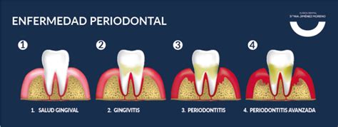 Infografía: Mecanismos por los cuales la enfermedad periodontal afecta el embarazo