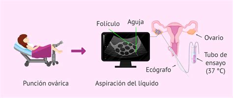 Ilustración esquemática del procedimiento de punción folicular