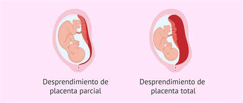 Esquema anatómico que muestra la diferencia entre una placenta insertada correctamente y una con desprendimiento prematuro