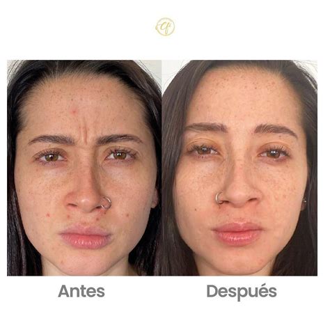 Infografía mostrando el antes y después del uso de la crema en piel con eccema atópico