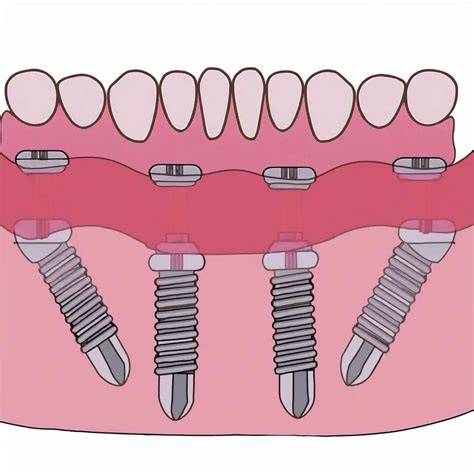 Esquema o infografía sobre implantes angulados en maxilares atróficos