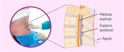 Diagrama de la colocación de la anestesia epidural en la columna lumbar