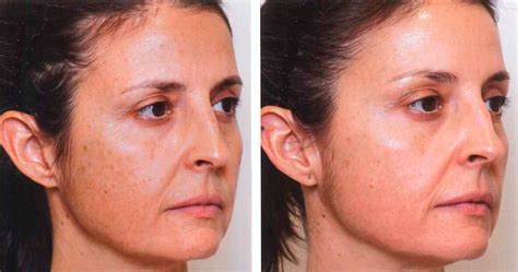 Fotografías de antes y después de tratamientos con exosomas en pacientes con acné y arrugas