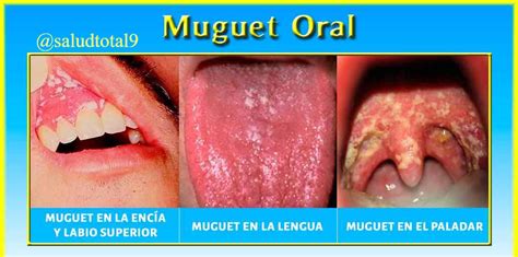 Primer plano de la boca de un bebé con candidiasis oral (muguet)