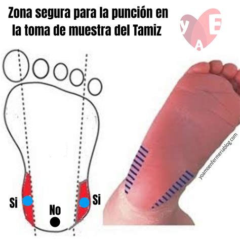 Punción del talón en un recién nacido