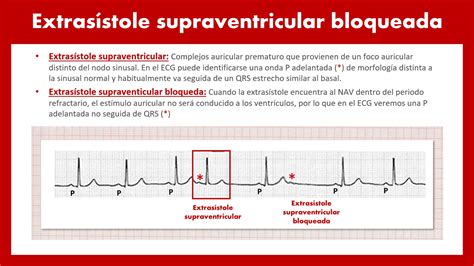 Comparación de extrasístoles supraventriculares y ventriculares en el ECG