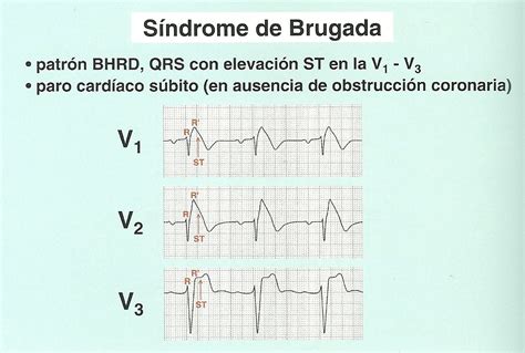 Ejemplo de patrón ECG del Síndrome de Brugada