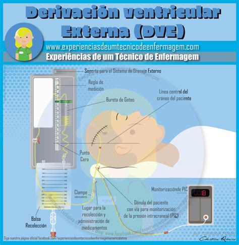 Infografía sobre la estructura y función del Drenaje Ventricular Externo