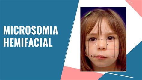 Imágenes comparativas de grados de microsomía hemifacial según clasificación de Pruzansky (Grado I, II, III)