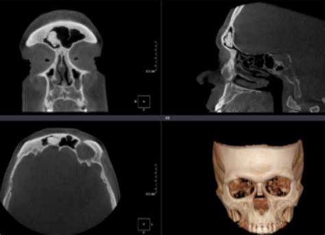 Tomografía computarizada 3D mostrando deformidad craneofacial